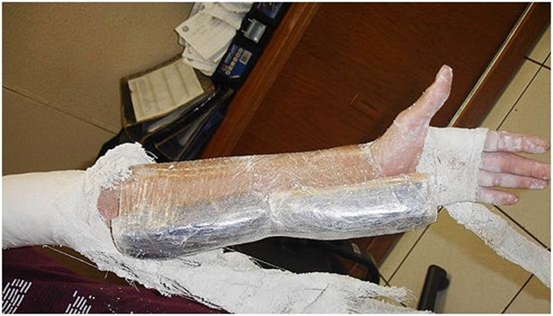 Bra&ccedil;o de adolescente estava engessado para esconder 610 gramas de crack; droga seria distribu&iacute;da no PR (Foto: Divulga&ccedil;&atilde;o/PF)