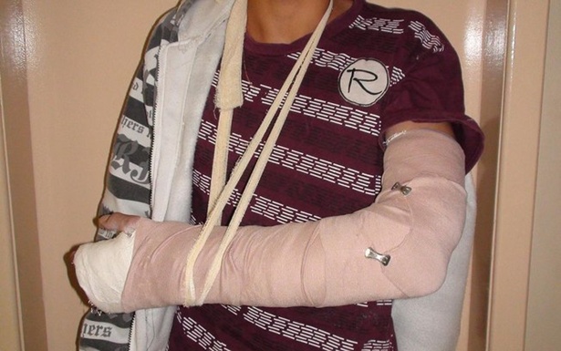 Adolescente afirmou aos policiais que havia quebrado o bra&ccedil;o h&aacute; alguns dias (Foto: Divulga&ccedil;&atilde;o/PRF)